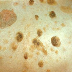 Example of skinLumpsAndBumps